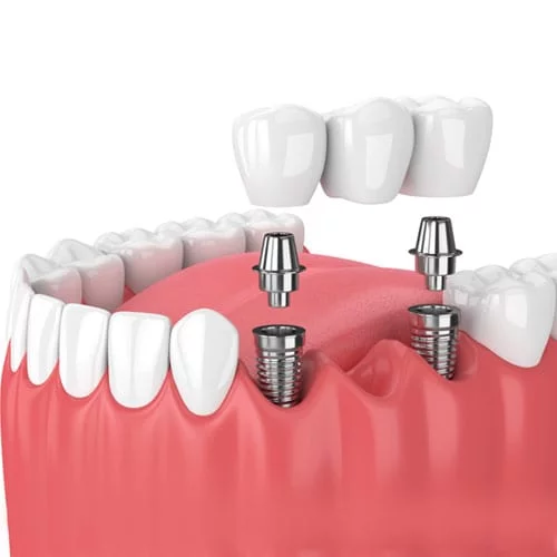 dental implant in toronto