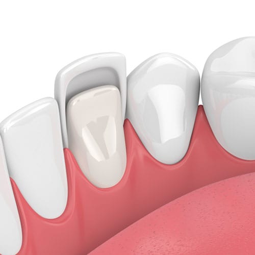 dental veneers up-close