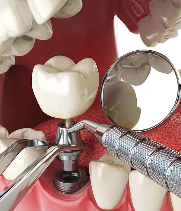 Dental Implants