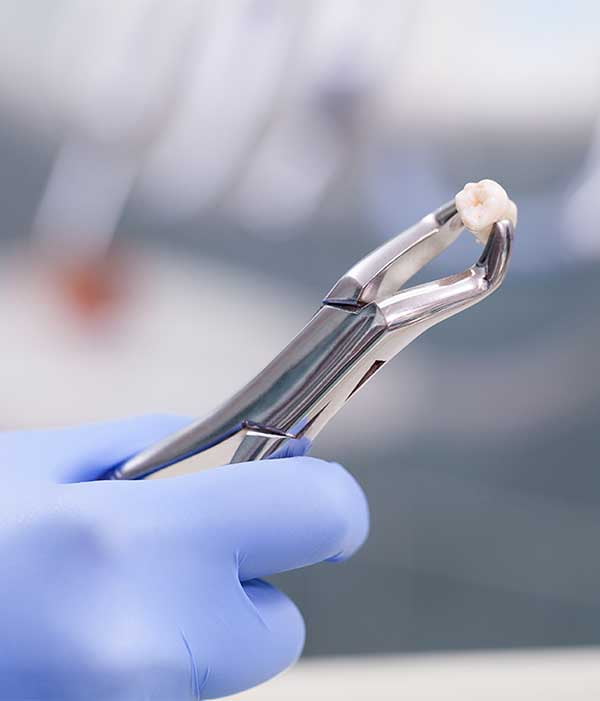 Teeth Extractions