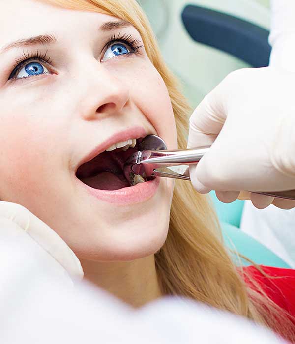 Teeth Extractions in yonge and eglinton