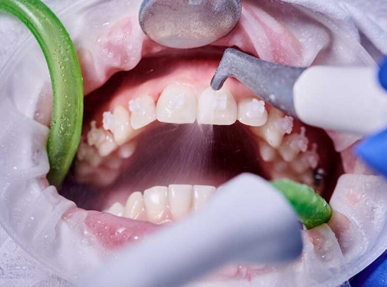Professional Teeth Cleaning