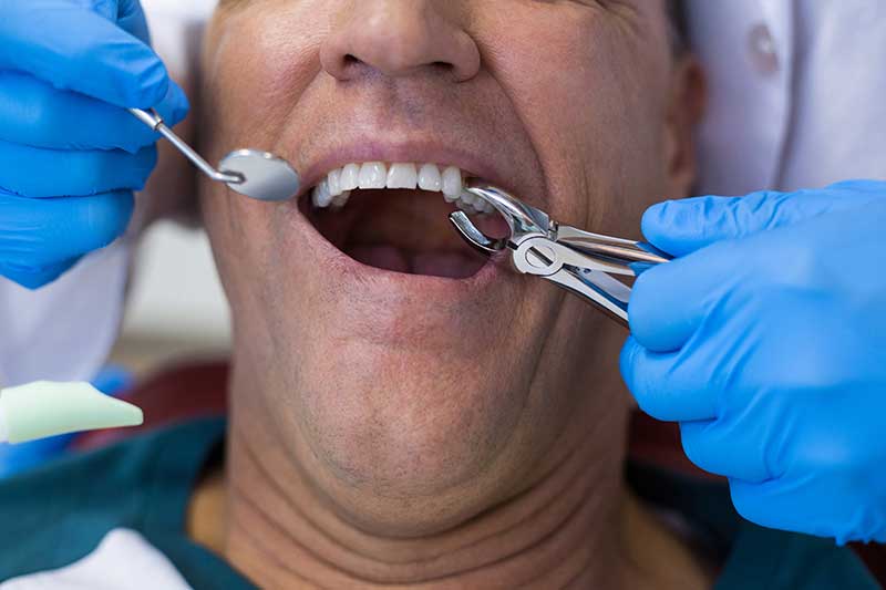 emergency teeth extraction