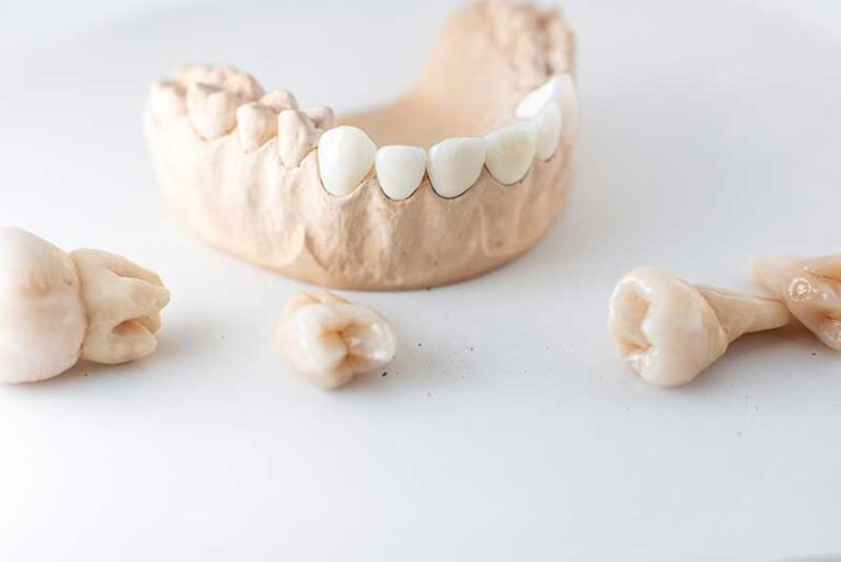 Dental Crowns and Bridges